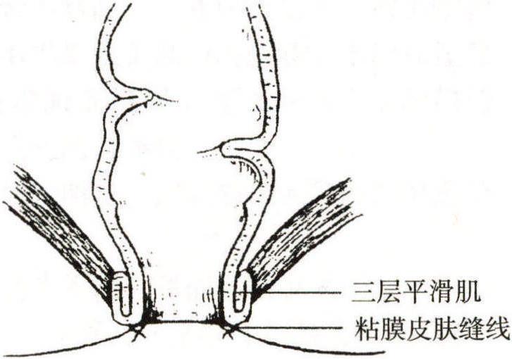 (十一)乙狀結(jié)腸平滑肌折疊肛門(mén)肛管重建術(shù)